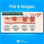 Pioneer Woman Colon Cancer Stage 4: a Comprehensive Guide