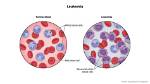 Why Is Leukemia Not Staged Like Other Cancers? Unraveling the Difference